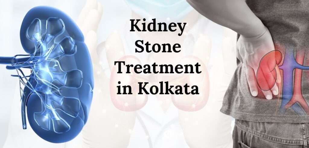 Kidney Stone Treatment in Kolkata