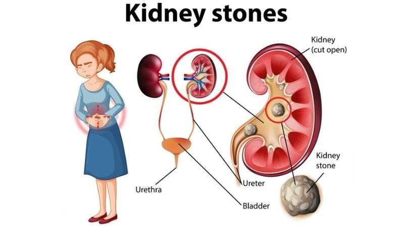 kidney stone treatment in kolkata
