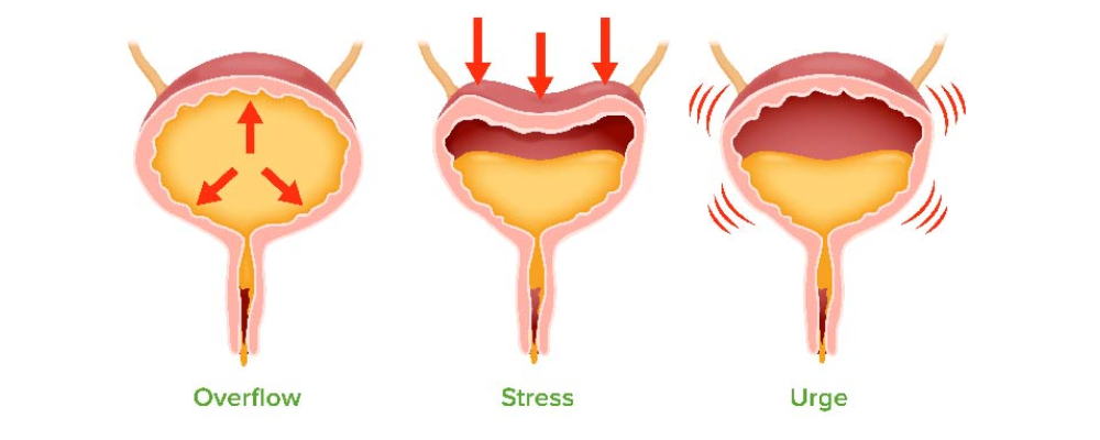 Urinary Incontinence Treatment