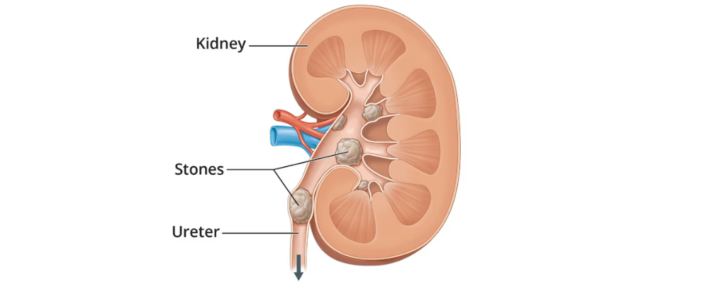 Kidney Stone Treatment