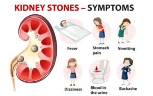 Kidney Stones Symptoms