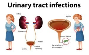 Urinary Tract Infections