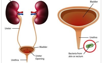 Urinary Incontinence Treatment